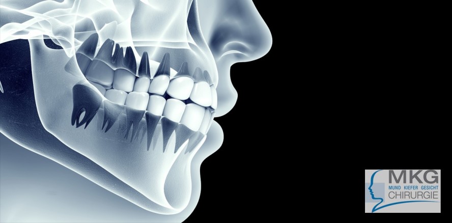Krebsmedikamente: Problemfalle Kieferknochen