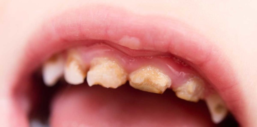 Mundhygiene der Tochter vernachlässigt: Eltern verhaftet