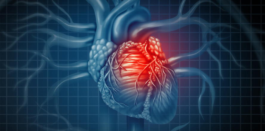 Kinder mit Karies haben später erhöhtes Herzinfarktrisiko