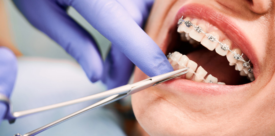 Länder kippen die Etablierung des Fachzahnarztes für KFO