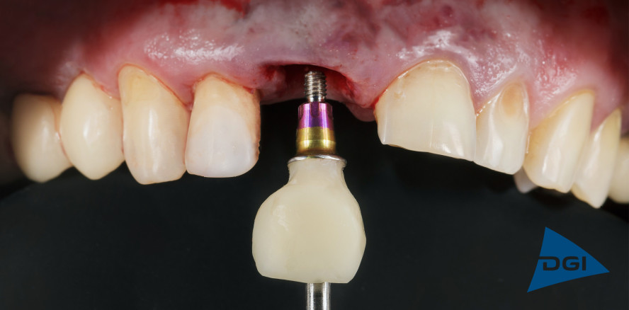 EuroPerio9: Periimplantitis erstmals klassifiziert