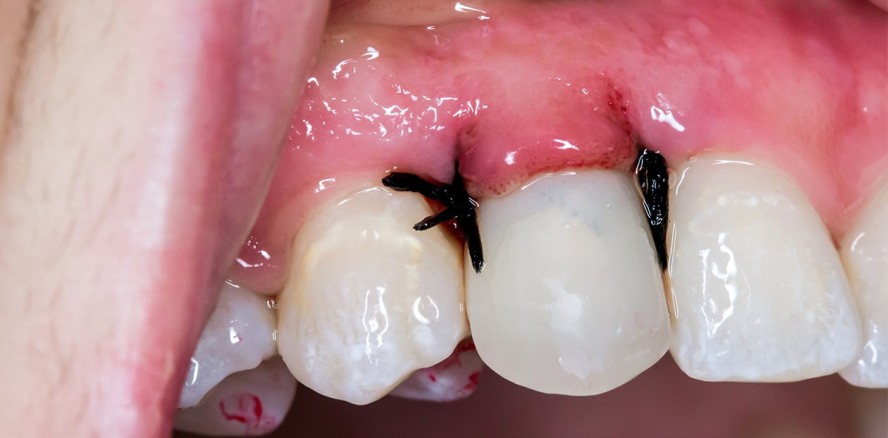 Zu wenig Knochen für Implantat: 40.000 Euro Schmerzensgeld