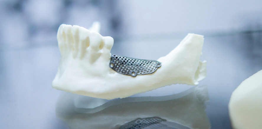 Maßgefertigte Knochengerüste aus dem 3D-Drucker