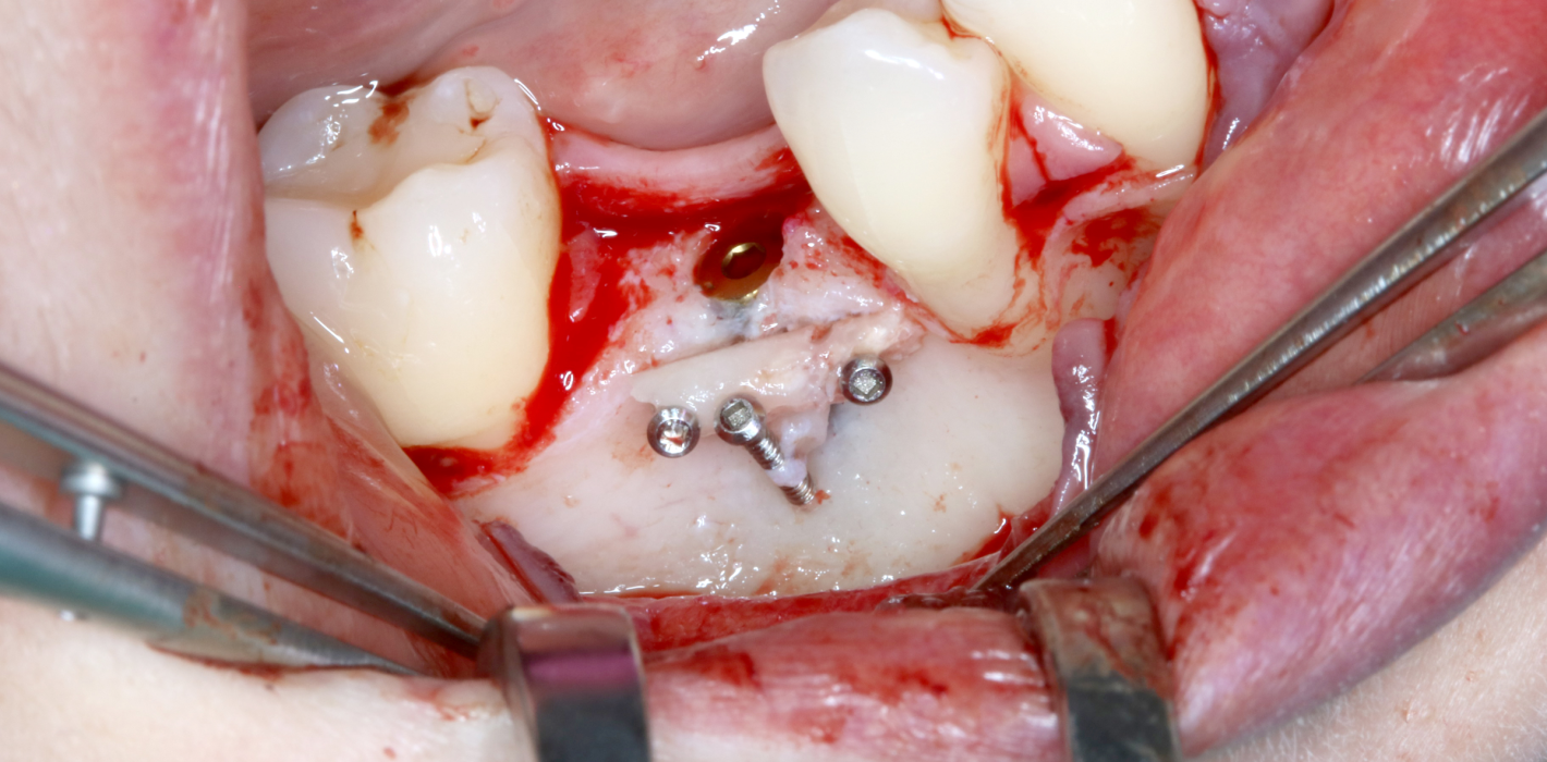 Komplexe Implantation im Seitenzahngebiet