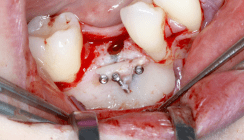 Komplexe Implantation im Seitenzahngebiet