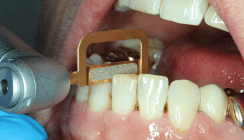 Konturierung von Zähnen und Füllungen: Eine Routineaufgabe in der KFO-Praxis