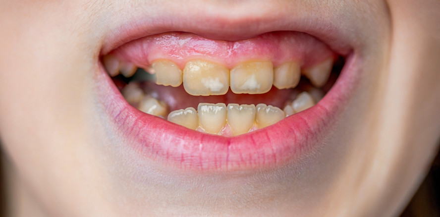 Früh erkennen, richtig behandeln: Kreidezähne bei Kindern