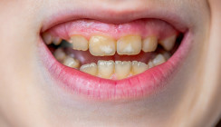 Früh erkennen, richtig behandeln: Kreidezähne bei Kindern