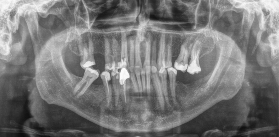 Der längste Zahn der Welt: Offenbach schlägt Indien mit 37,2 mm