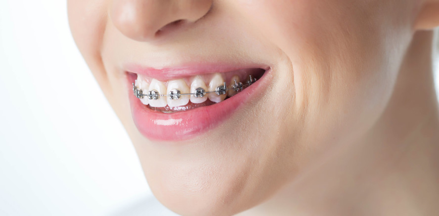 Laser statt Schmerzmittel bei KFO-Behandlungen?