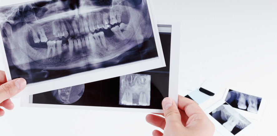 Neue S3-Leitlinie: Rehabilitation von Patienten mit Zahnnichtanlagen