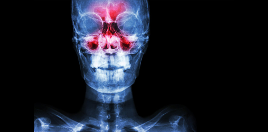 Aktualisierte S2k-Leitlinie: „Odontogene Sinusitis maxillaris“