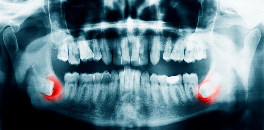 Neue S2k-Leitlinie: „Operative Entfernung von Weisheitszähnen“