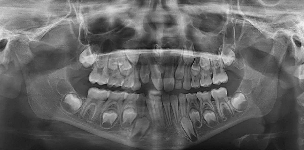 Mesiodens mit enger Lagebeziehung zur Apertura piriformis