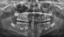 Mesiodens mit enger Lagebeziehung zur Apertura piriformis