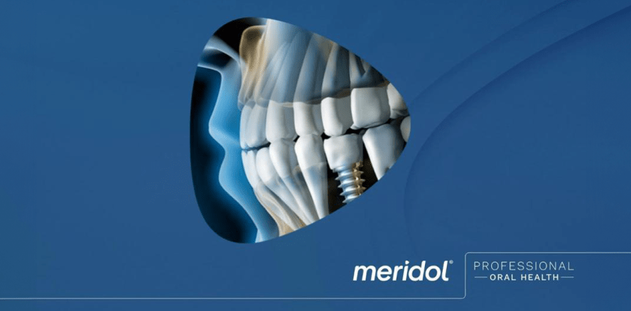 Klinische Studien mit Implantat­trägern: Periimplantitis vorbeugen