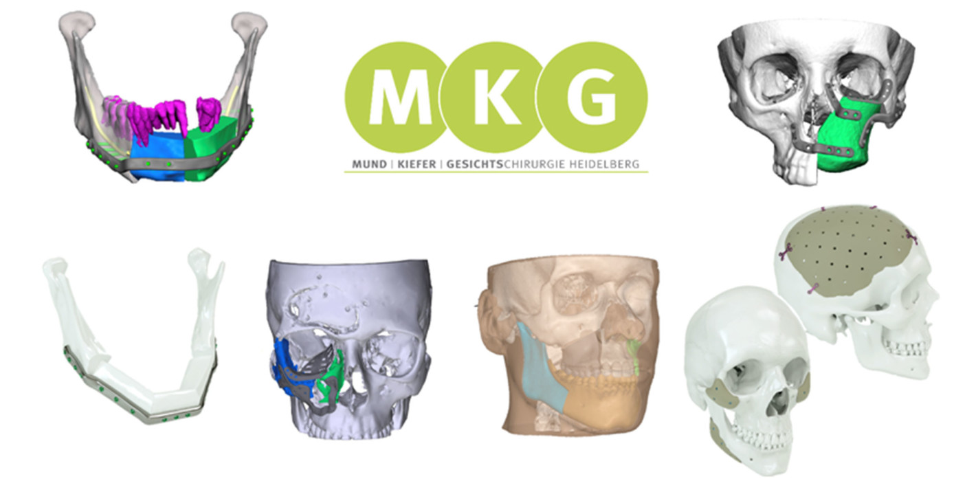 Millionenförderung: Individueller 3D-Druck für Patienten in der MKG