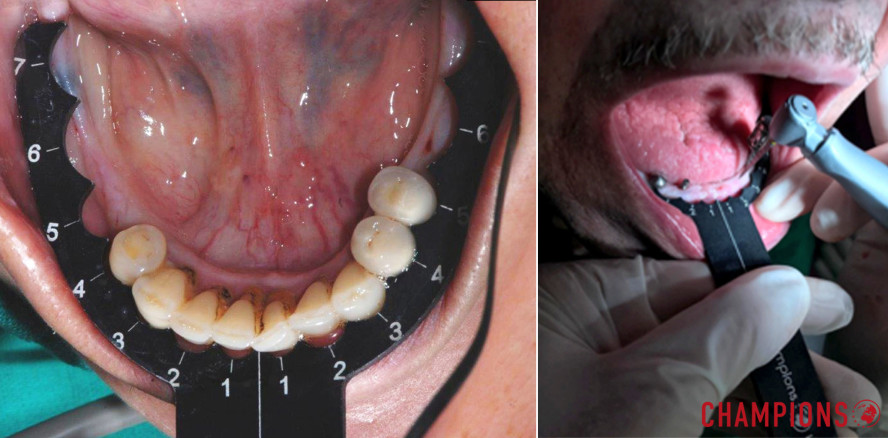 MIMI-Verfahren: „Implantologie gehört in jede Praxis“