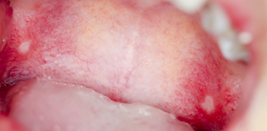 Keratinozyten-Wachstumsfaktor gegen orale Mukositis