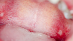 Keratinozyten-Wachstumsfaktor gegen orale Mukositis