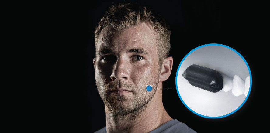 „Molar Mic“ – Telefonieren bald über die Zähne möglich?