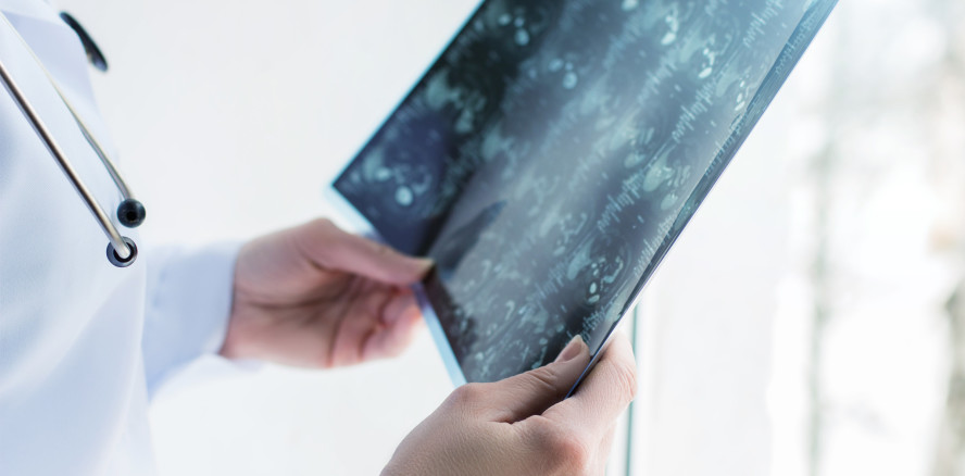 Mund-Rachen-Krebs: Chemotherapie vs. Roboter-OP