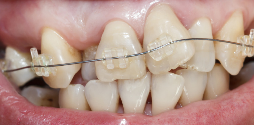 Nanopartikel für erfolgreichere kieferorthopädische Behandlung