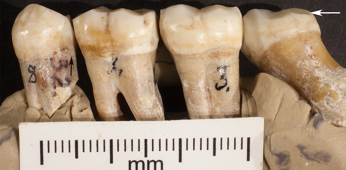 Auch Neandertaler praktizierten schon Zahnmedizin