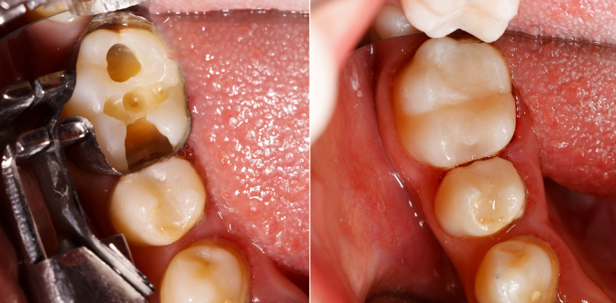 Neues Füllungsmaterial könnte Komposite ablösen