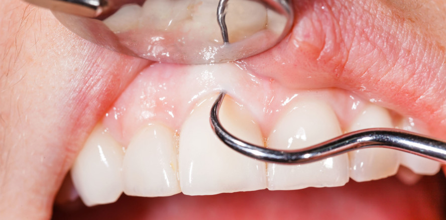 ÖGP begrüßt Aufwertung der Parodontitisbehandlung