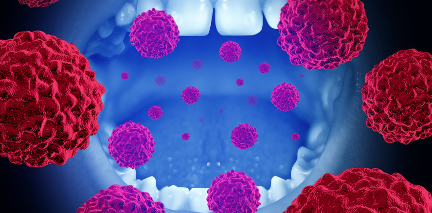 Parodontitisbakterien bevölkern Mundhöhlenkarzinome