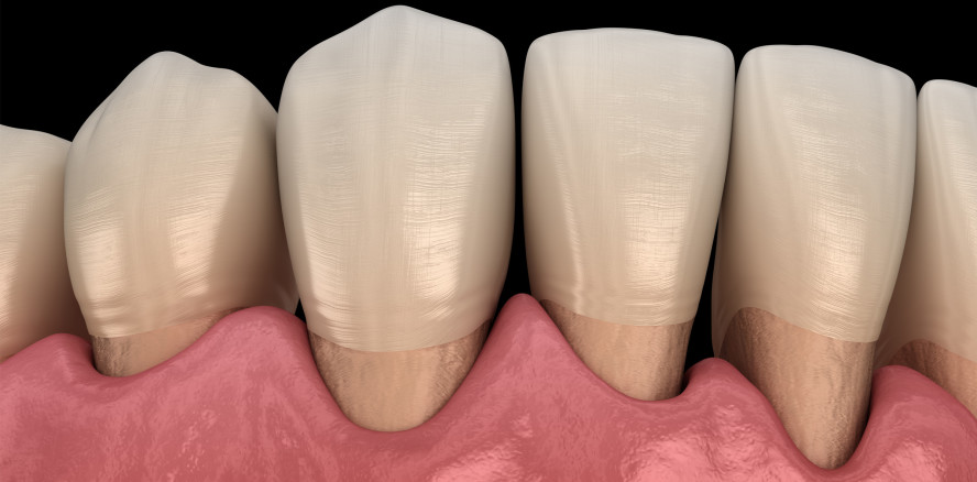 Parodontitis: Membran zur Geweberegeneration entwickelt