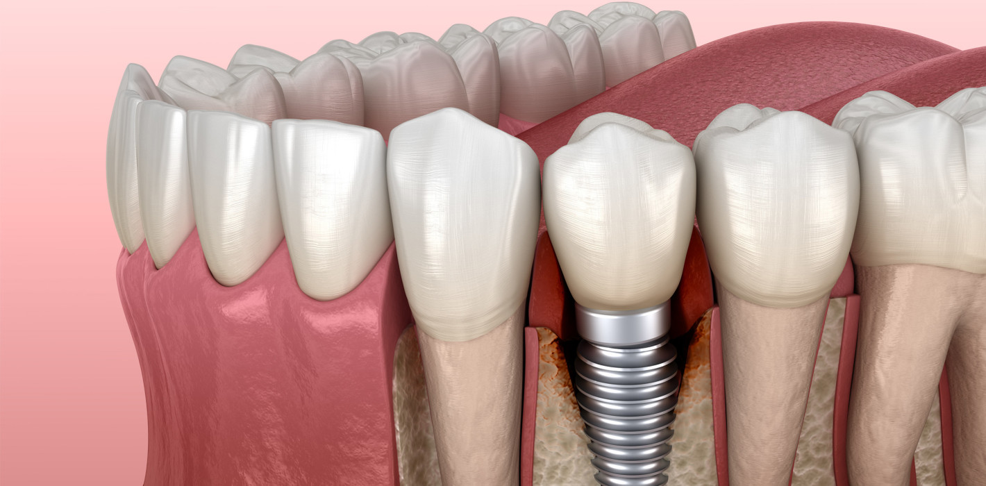 Prophylaxe: Peptide gegen Parodontitis und Periimplantitis
