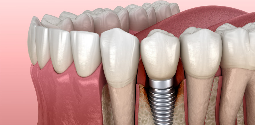 Prophylaxe: Peptide gegen Parodontitis und Periimplantitis