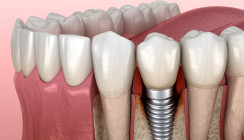 Prophylaxe: Peptide gegen Parodontitis und Periimplantitis