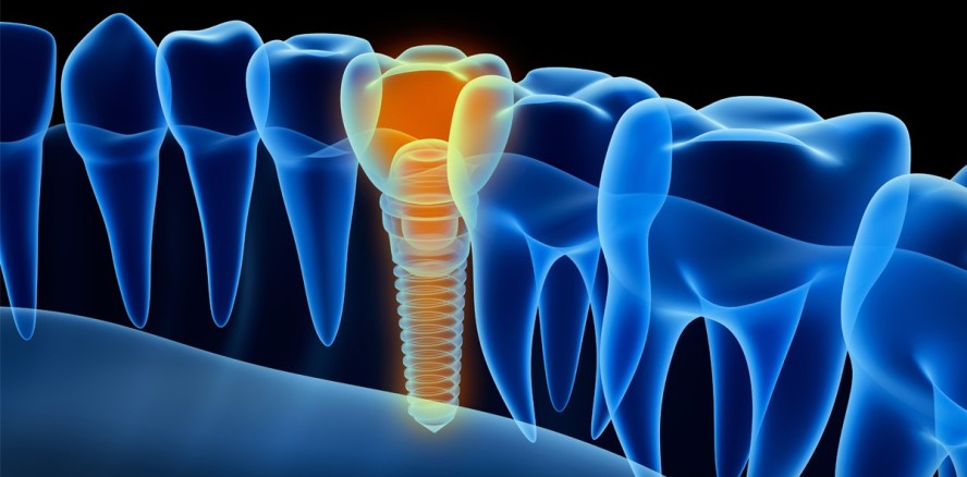 Forscher testen neue Methode zur Periimplantitisbehandlung