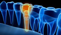 Forscher testen neue Methode zur Periimplantitisbehandlung