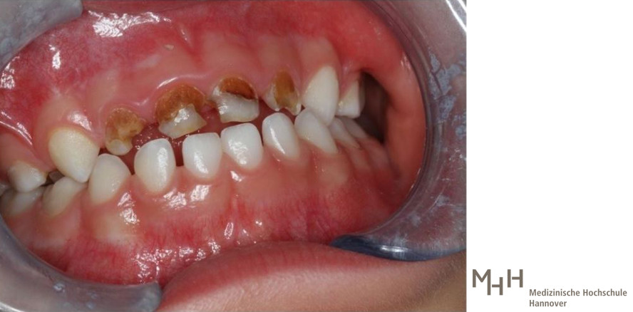 Karies und Kreidezähne: Schlechte Zähne bei Kindern nehmen zu