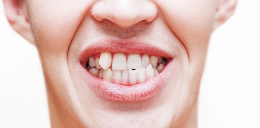 Urteil am OLG: Eine Zahnfehlstellung ist keine Anomalie