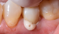 Die effiziente postendodontische Behandlung