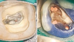 Der präendodontische Aufbau