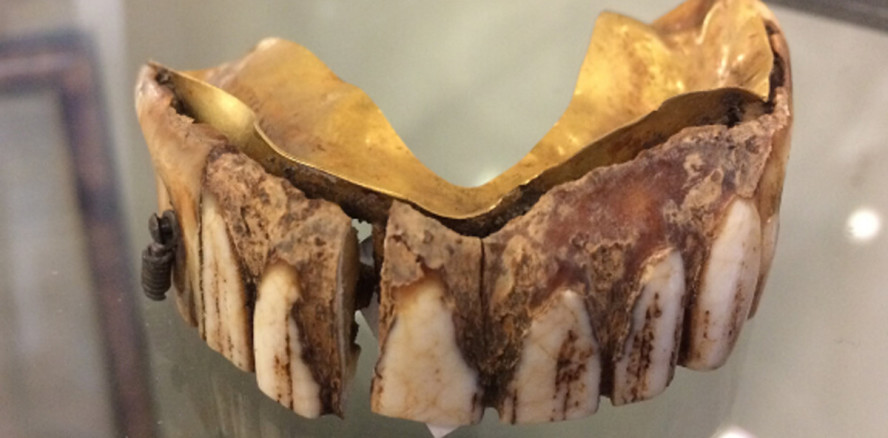 Adlige trugen schon vor 200 Jahren raffinierte Prothesen