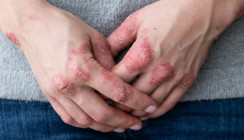 Psoriasis: Gute Mundgesundheit mildert Symptome