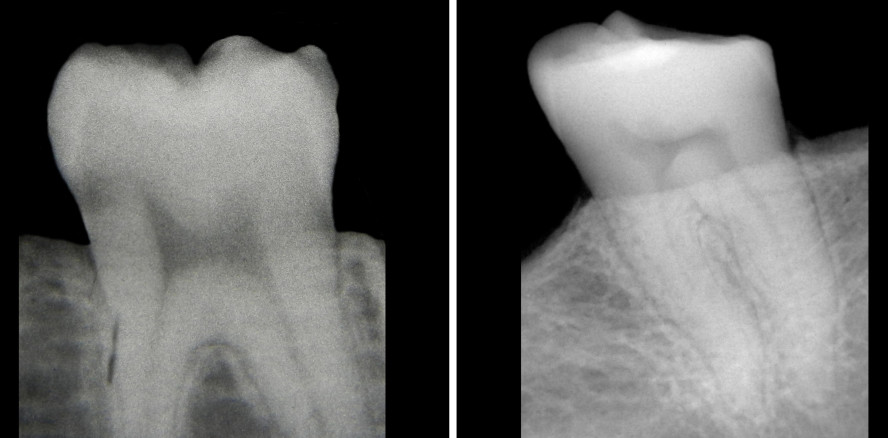 Röntgen beim Zahnarzt enthüllt Vitamin-D-Mangel