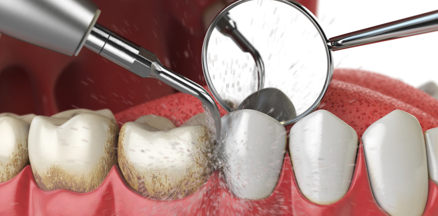 Professionelle Zahnreinigung in Praxis und Klinik