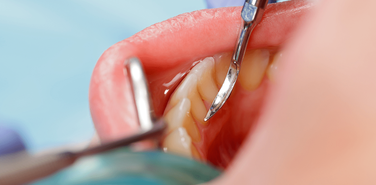 Abrechnungs-Tipp: Gingival- und Parodontalindizes