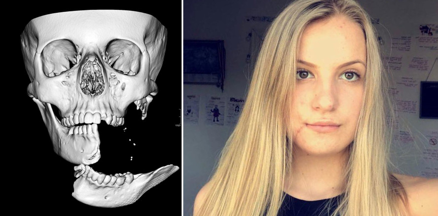 Kiefer hing am seidenen Faden: Chirurg vollbringt Wunder