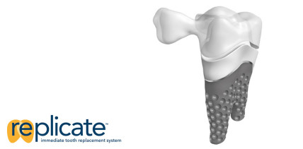 Innovatives Zahnimplantat: Exakte Kopie des eigenen Zahns