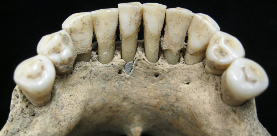 Was Zahnstein über die Rolle der Frau im Mittelalter verrät