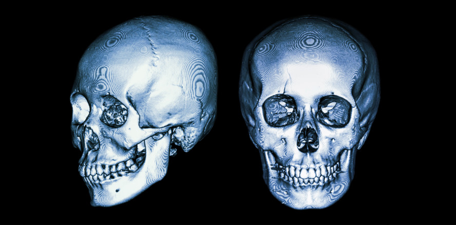 Weniger Röntgenaufnahmen – Schädelform in 3D berechnen
